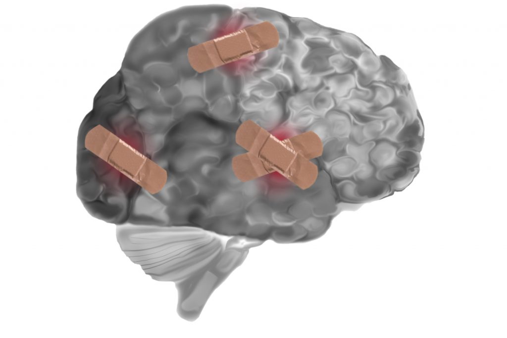 Picture of a bruised brain with bandages attached to represent an injury. 
