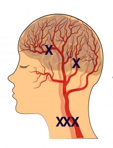 illustration of brain and blood vessels of the head.