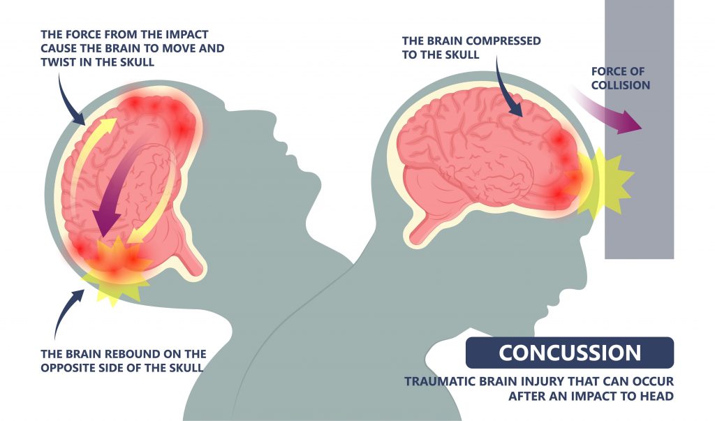 Brain injury from concussion